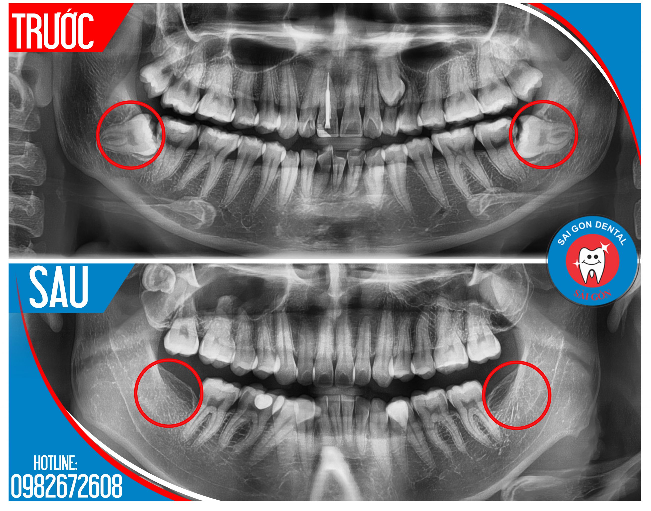 Tiểu phẫu răng khôn tại nha khoa Sài Gòn