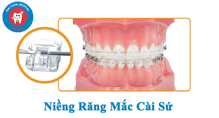 Niềng răng và những vấn đề cần biết khi niềng răng