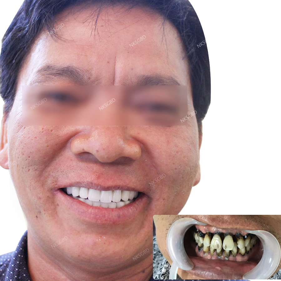 Phục hình răng bị mất do tai nạn