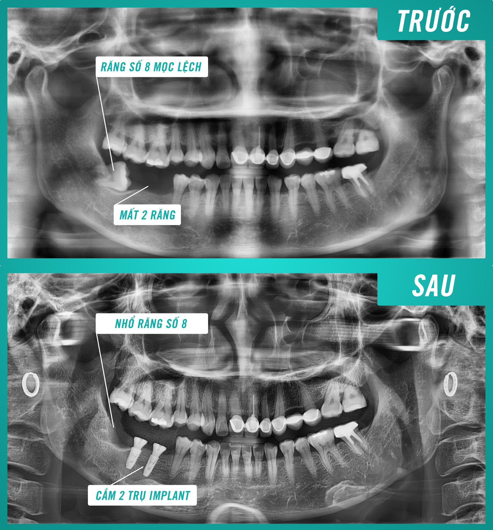 trồng implant tại bình dương