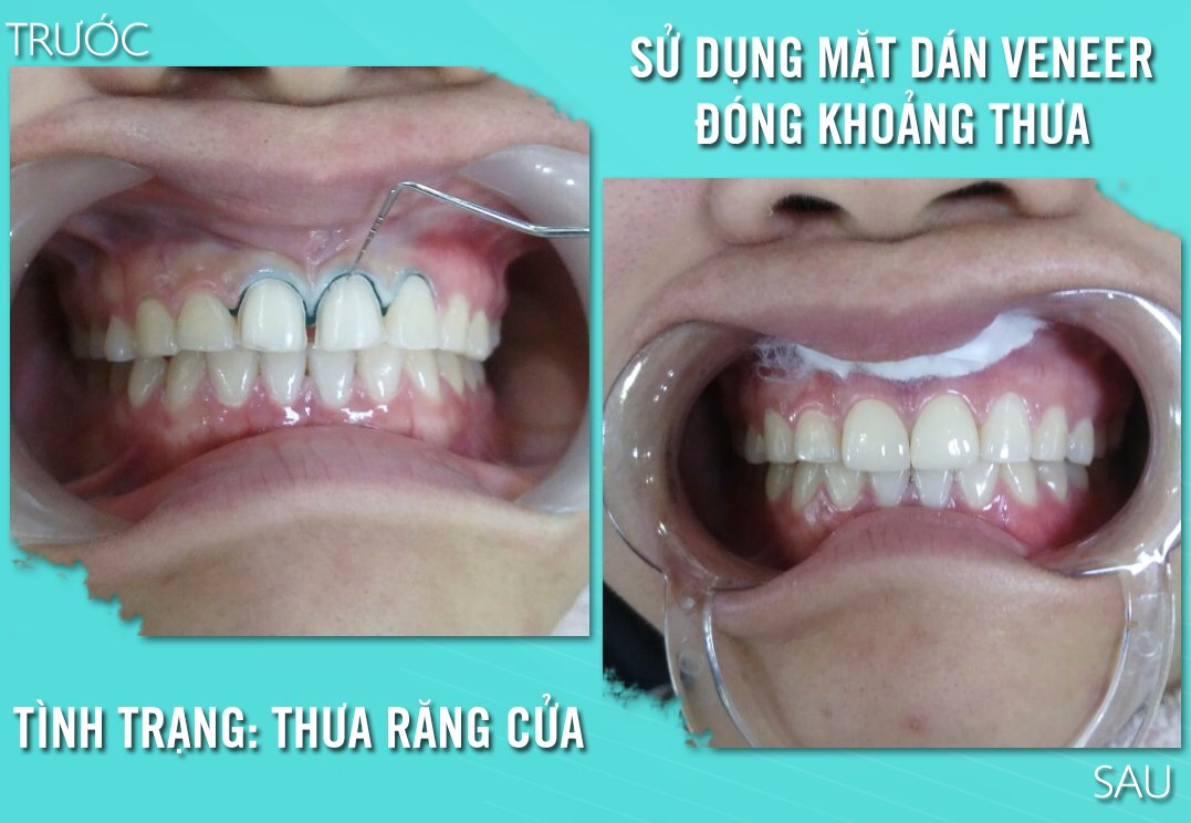 mặt dán sứ veneer tại nha khoa sài gòn
mặt dán sứ veneer tại nha khoa sài gòn