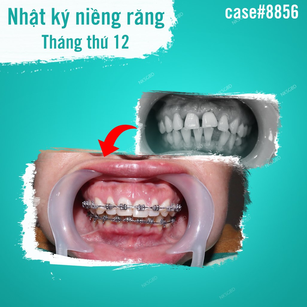 hình ảnh khách hàng sau 1 năm niềng răng tại nha khoa Sài Gòn Bình Dương