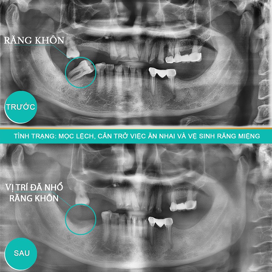 răng khôn mọc ngầm