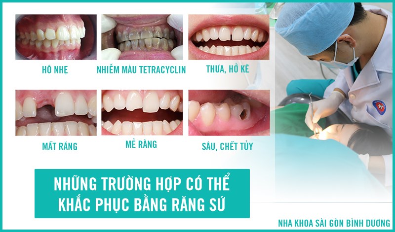 CÁC TRƯỜNG HỢP NÊN BỌC RĂNG SỨ CÁC TRƯỜNG HỢP NÊN BỌC RĂNG SỨ