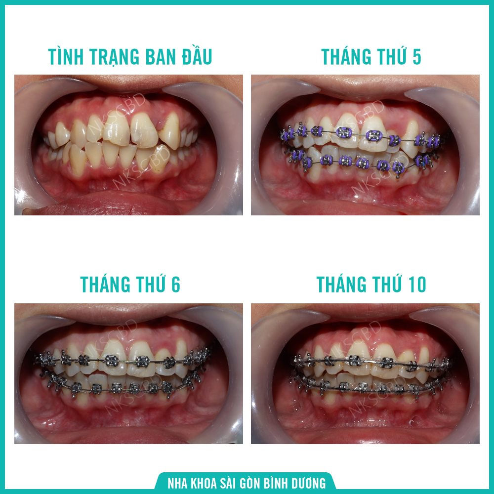 Hình ảnh khách hàng chỉnh nha tại nha khoa Sài Gòn Bình Dương
