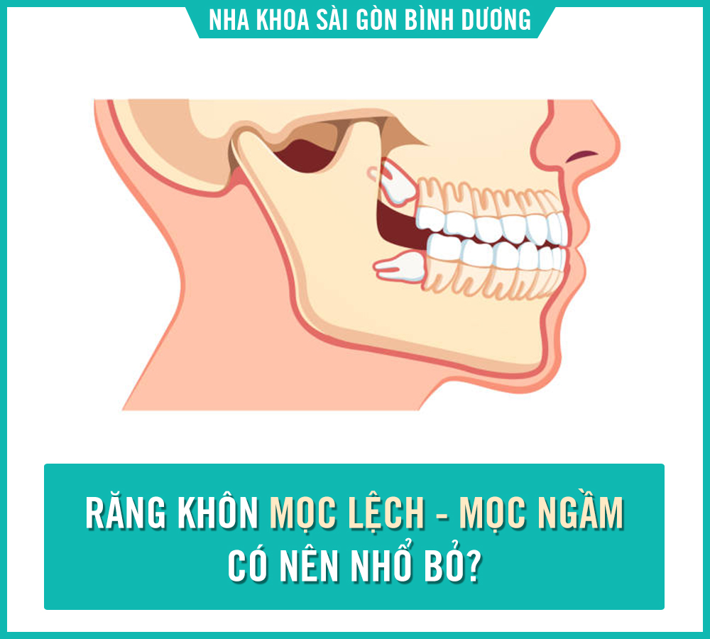 nhổ răng khôn tại nha khoa sài gòn
