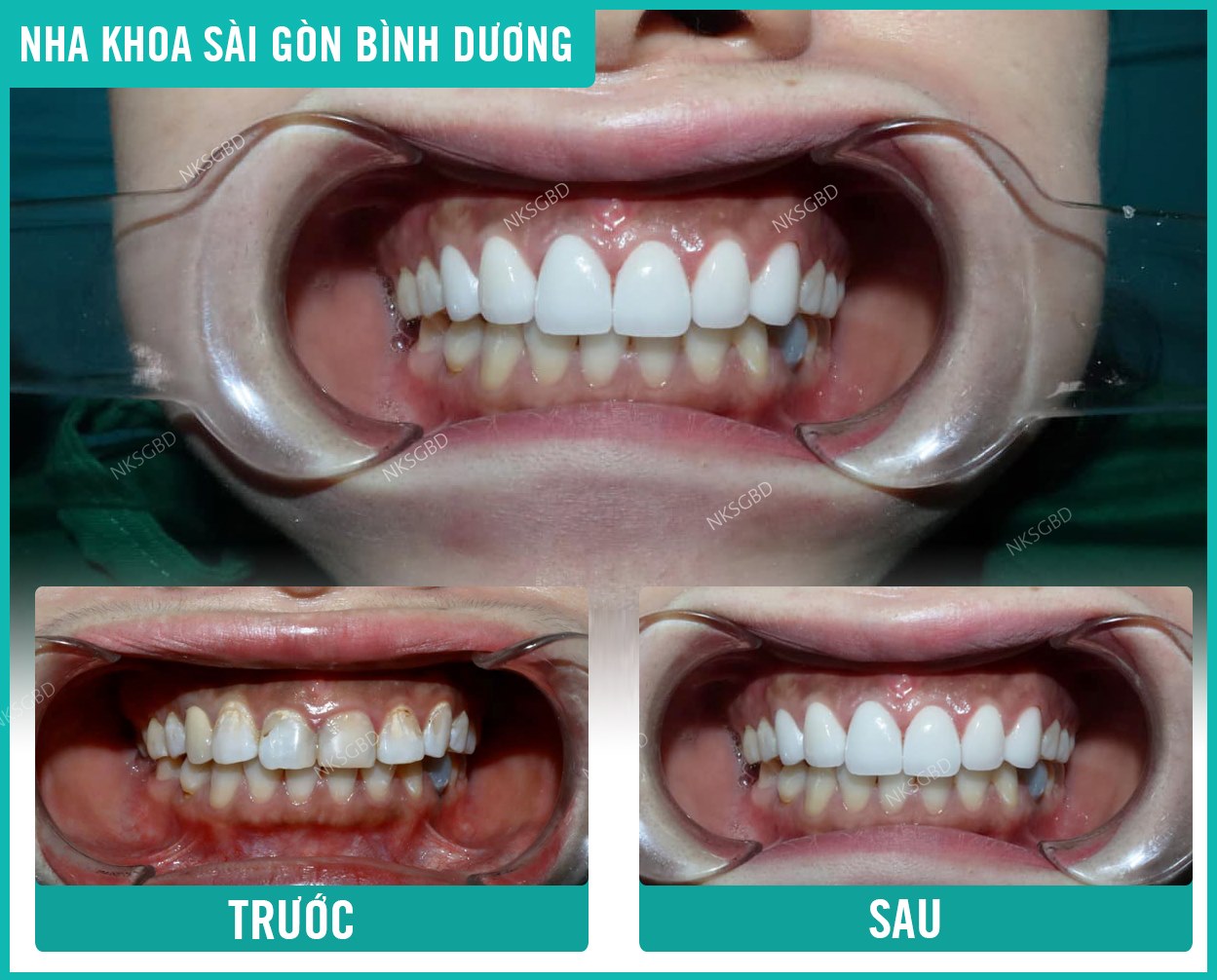 ưu điểm của phương pháp bọc răng sứ
ưu điểm của phương pháp bọc răng sứ