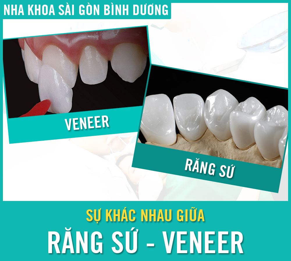 mặt dán sứ veneer mặt dán sứ veneer