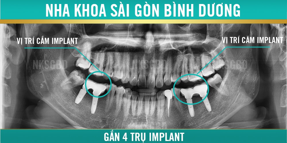 trồng implant khắc phục tình trạng mất răng