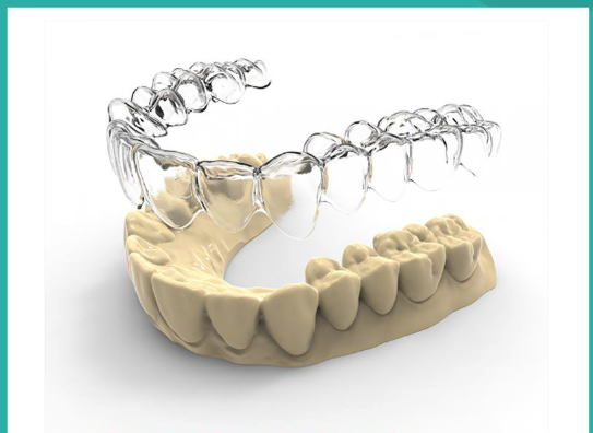 máng duy trì trong quá trình niềng răng