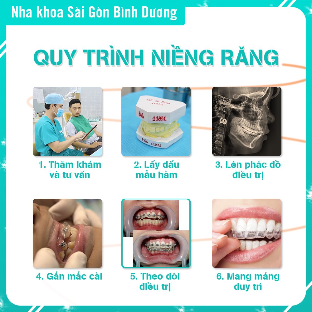 Quy trình niềng răng tại nha khoa Sài Gòn