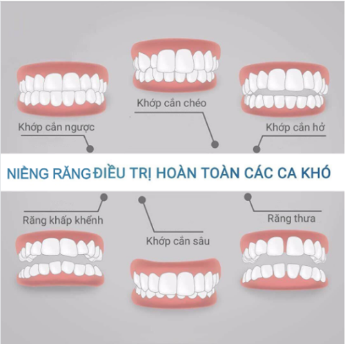 Các trường hợp nên sử dụng niềng răng mắc cài kim loại Các trường hợp nên sử dụng niềng răng mắc cài kim loại