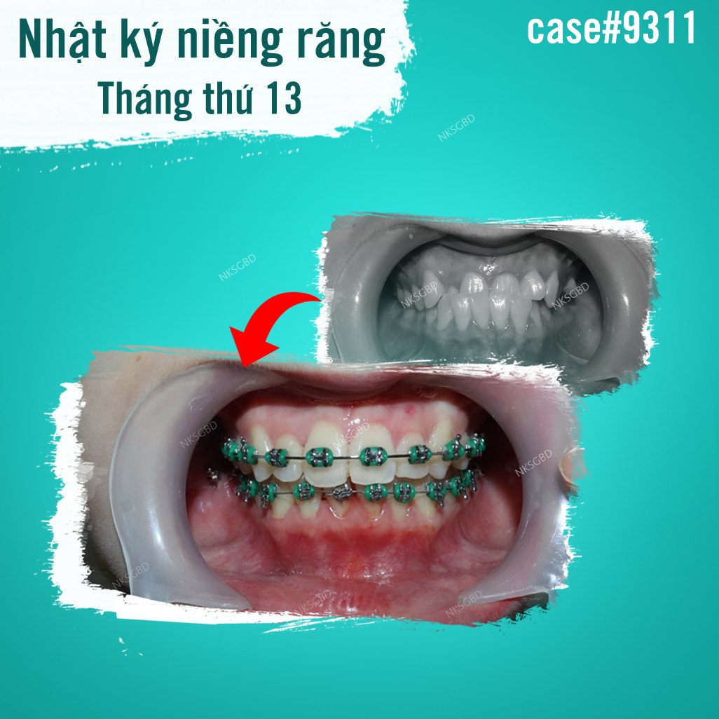 Mắc cài kim loại thông thường