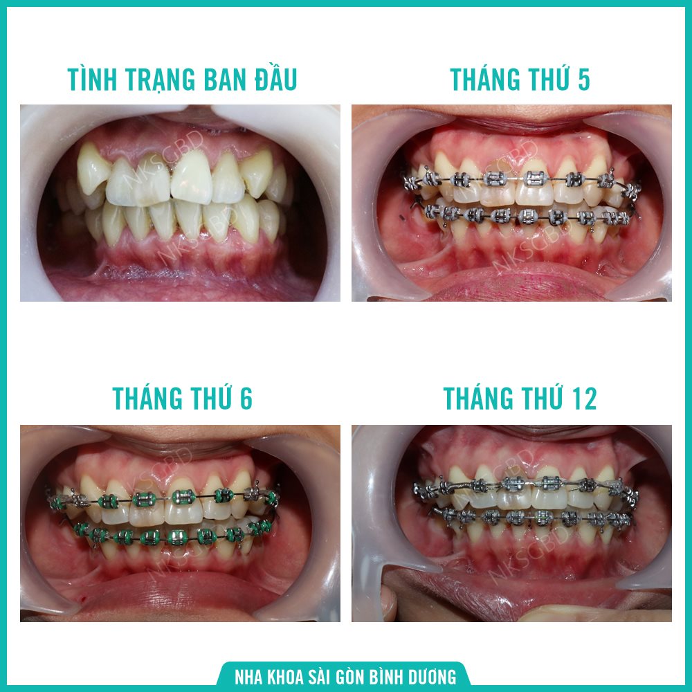 Khách hàng niềng răng sau 1 năm bằng mắc cài kim loại