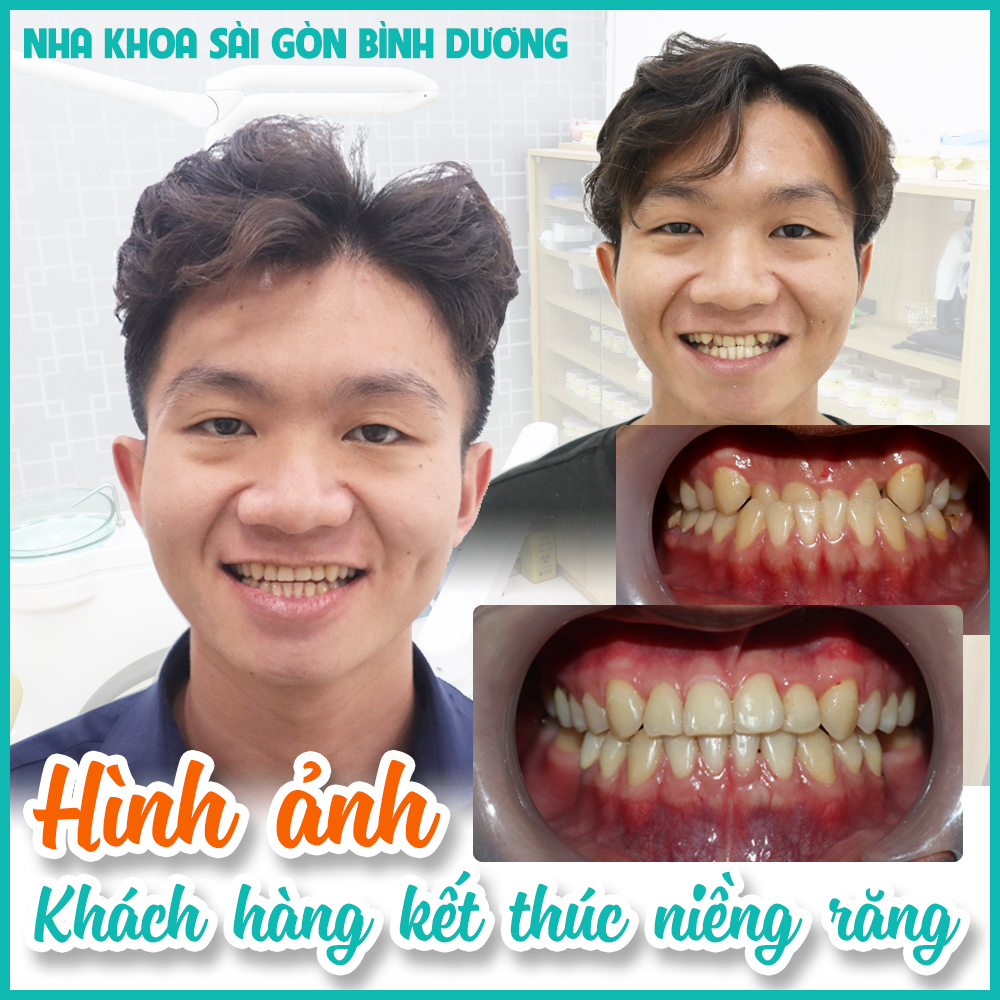 niềng răng mất bao lâu sẽ có kết quả niềng răng mất bao lâu sẽ có kết quả