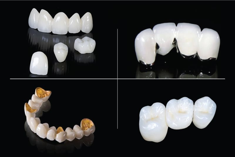 Nhổ răng bao lâu nên trồng lại răng Nhổ răng bao lâu nên trồng lại răng