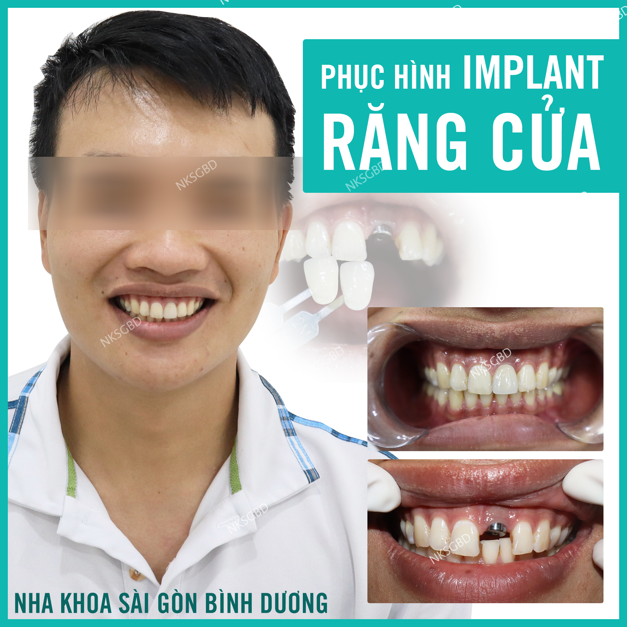 Cắm implant sau khi nhổ răng sâu