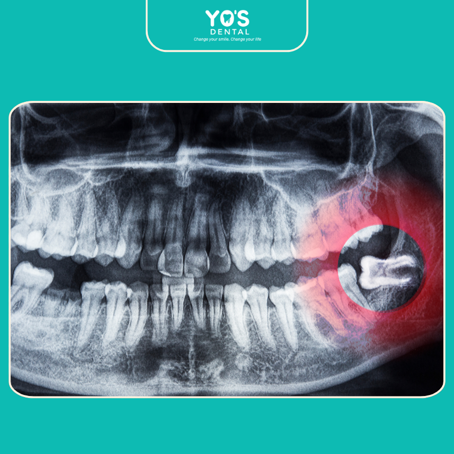 Lợi Ích Của Việc Nhổ Răng Khôn Sớm Lợi Ích Của Việc Nhổ Răng Khôn Sớm