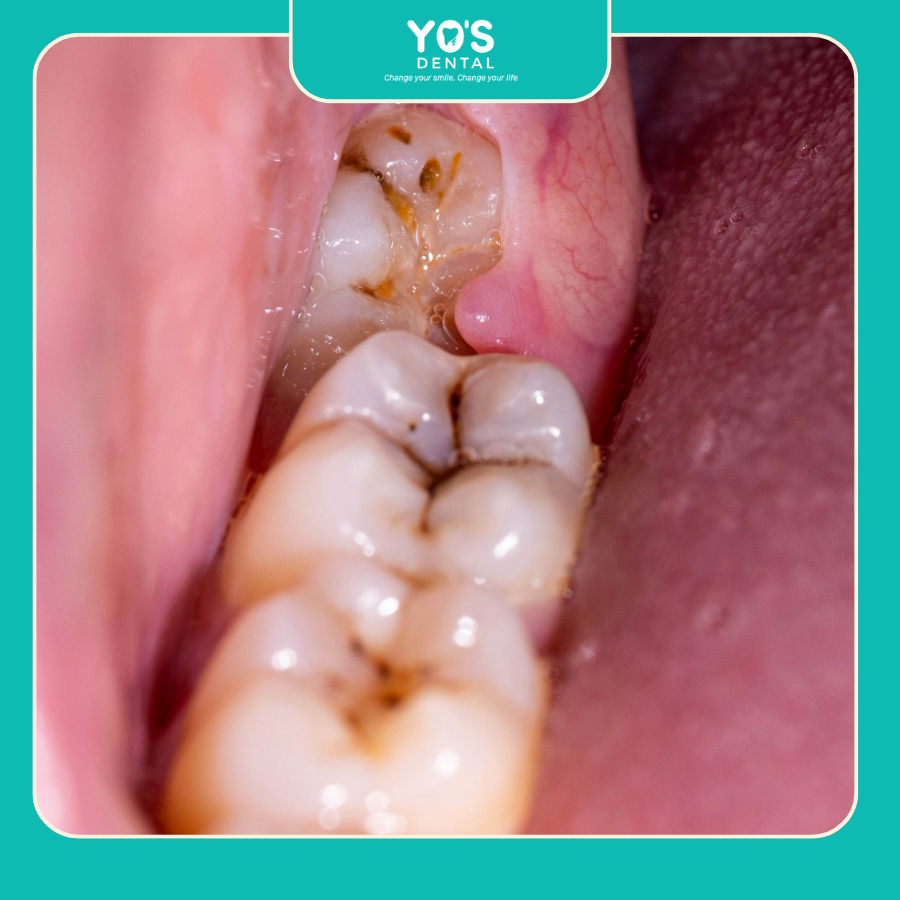 Sưng Nướu Và Viêm Quanh Răng Khôn Sưng Nướu Và Viêm Quanh Răng Khôn