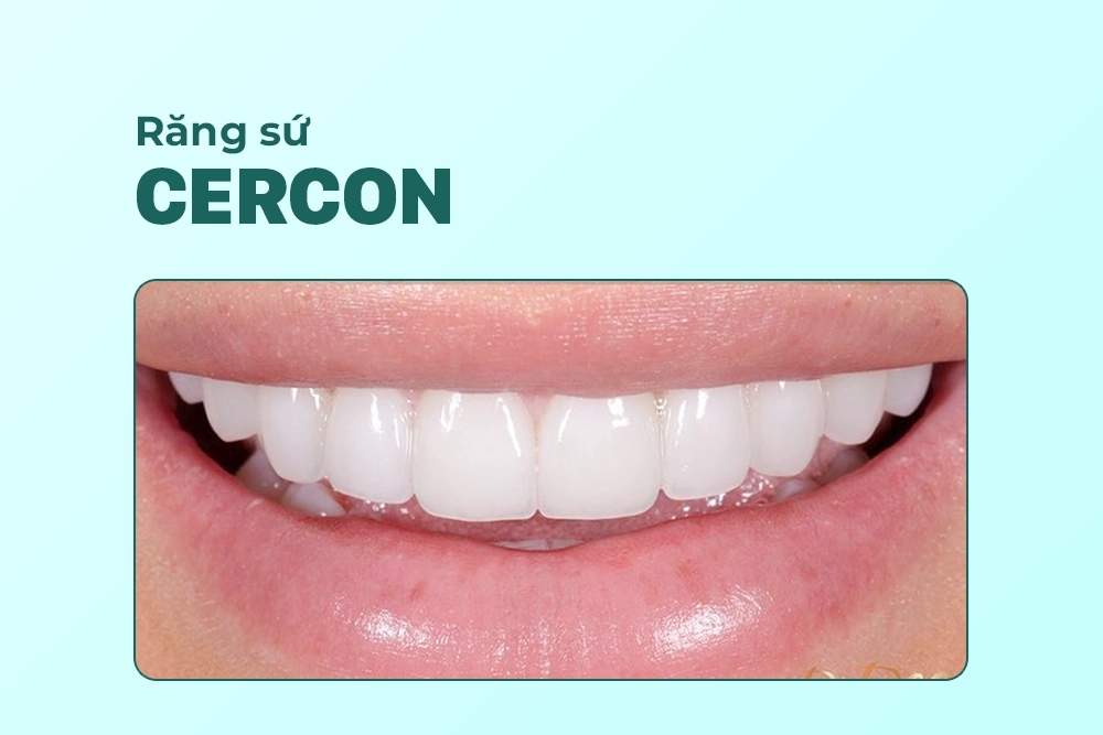Răng sứ Cercon