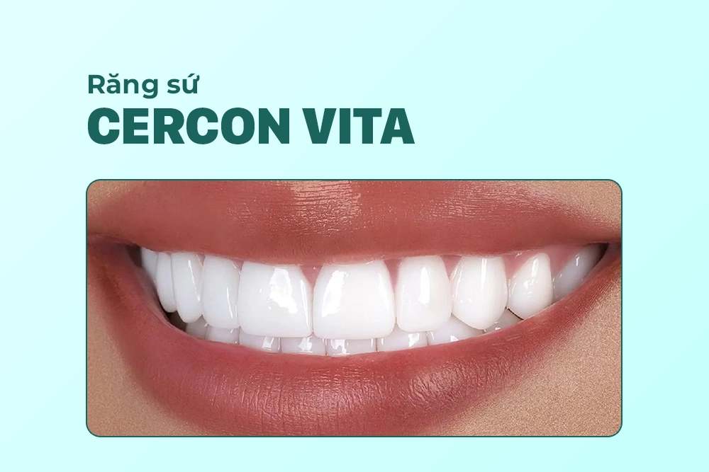 Răng sứ Cercon Vita