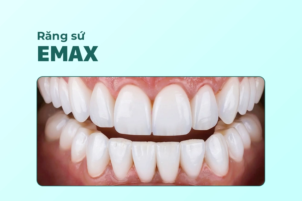 Răng sứ Emax