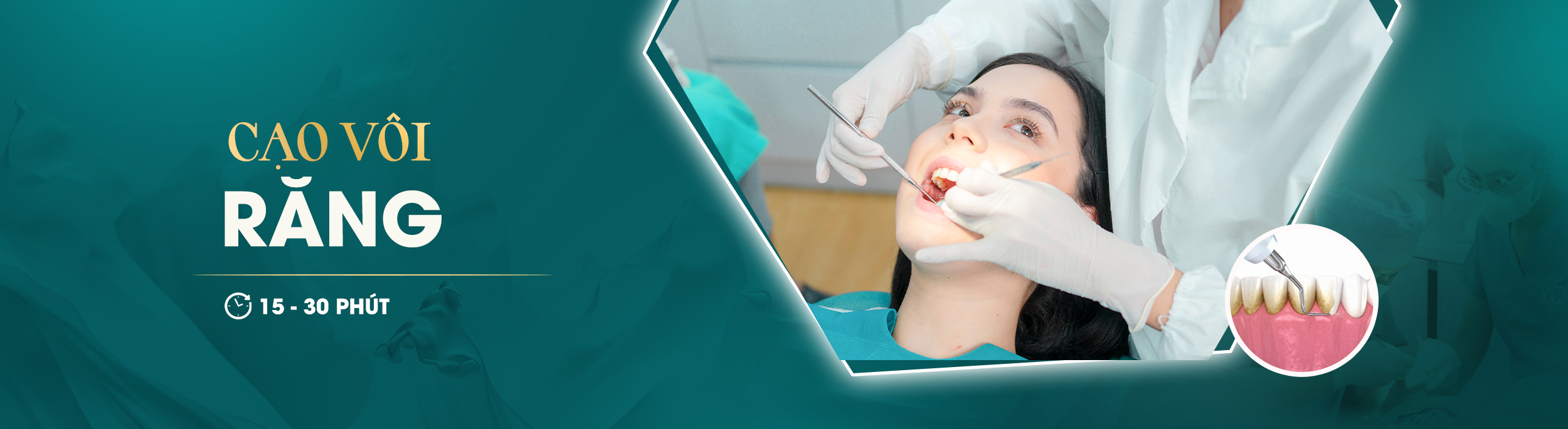 CẠO VÔI RĂNG
