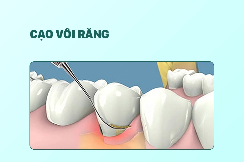 Cạo vôi răng