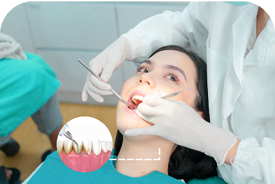 Cạo vôi răng Cạo vôi răng