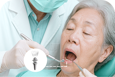 Cấy ghép Implant Cấy ghép Implant