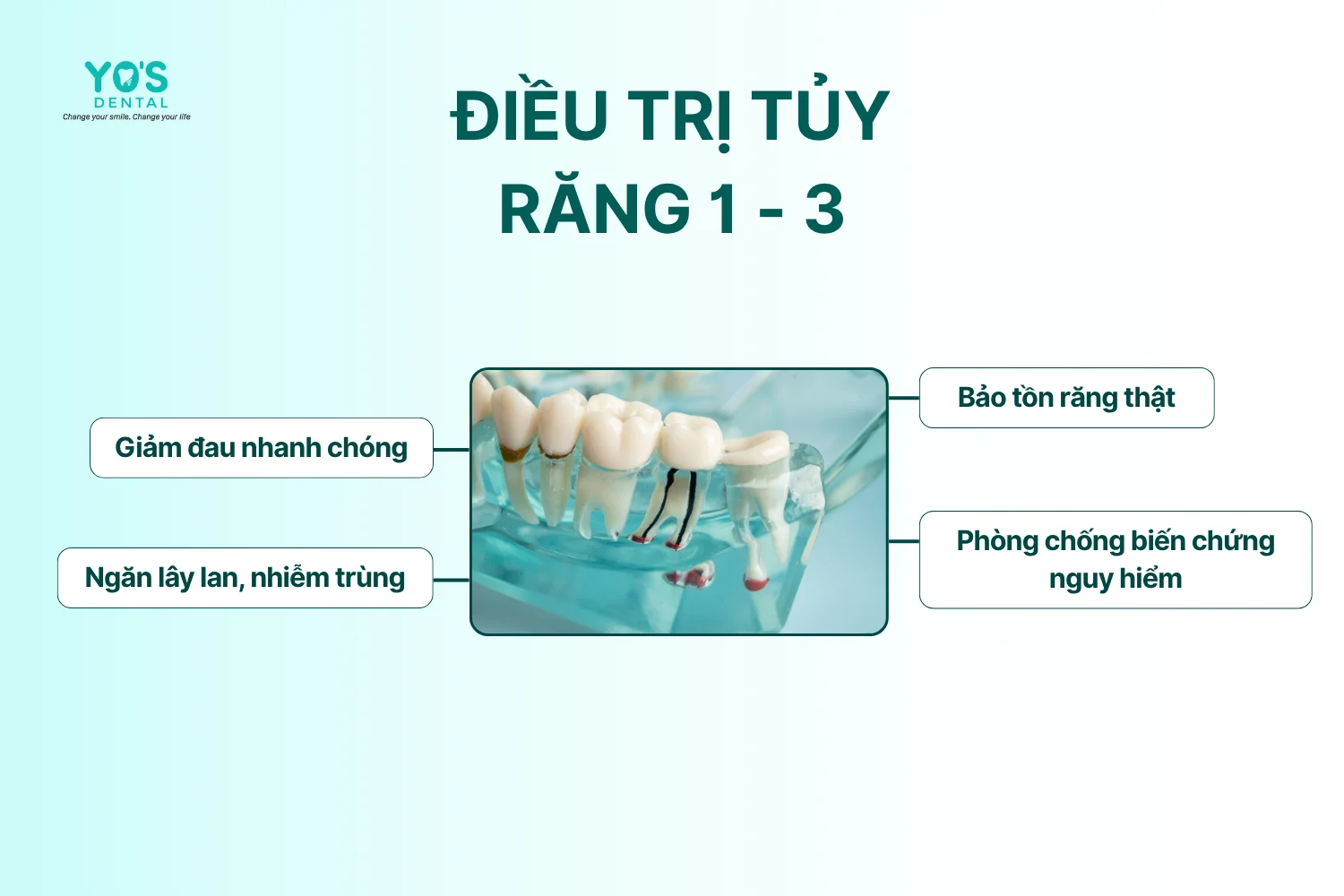 Điều trị tủy - Răng 1-3 - 090- 1
