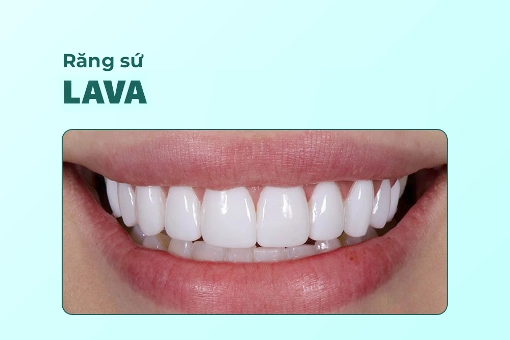Răng sứ Lava