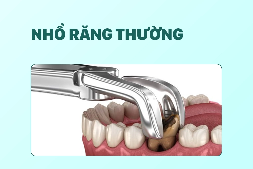 Nhổ răng thường