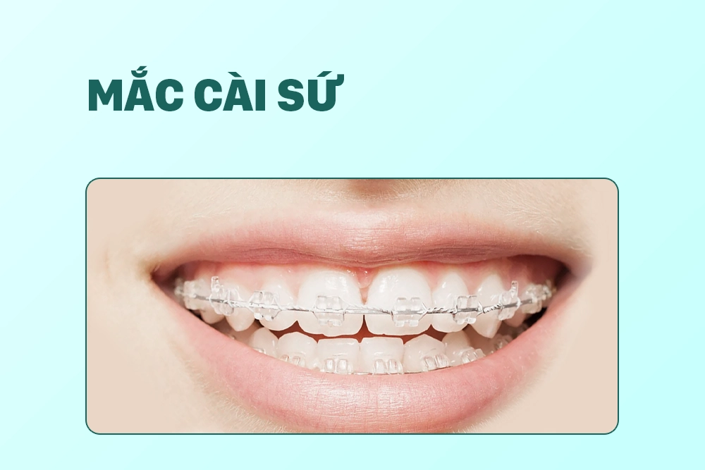 Mắc cài sứ