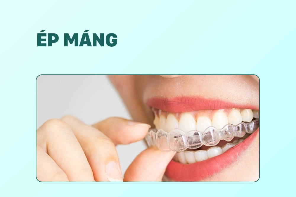 Ép máng (Niềng răng tại nha khoa)