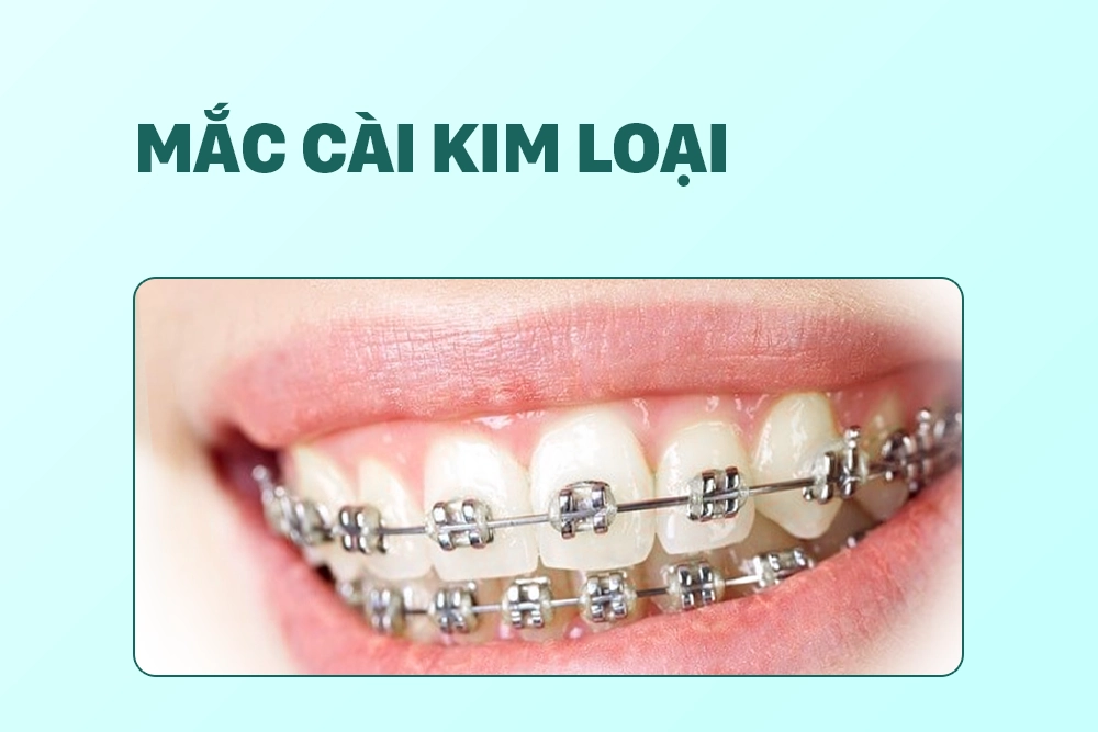 Mắc cài kim loại