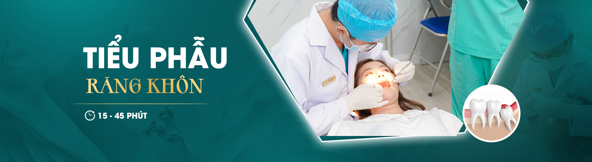 TIỂU PHẪU RĂNG KHÔN