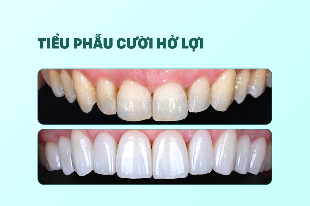 Tiểu phẫu cười hở lợi
