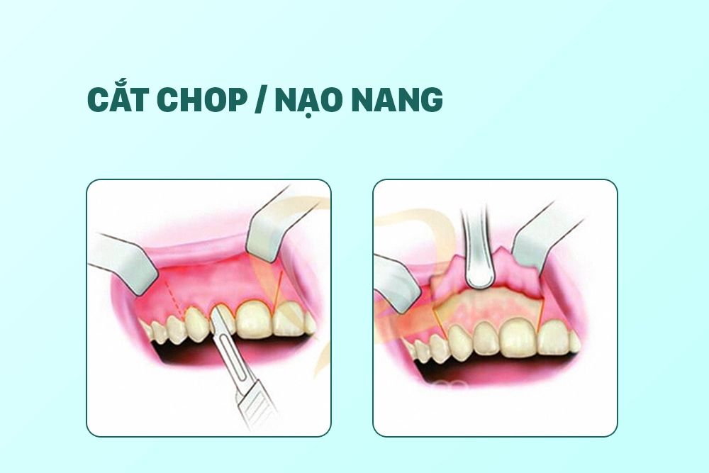 Cắt chop / nạo nang