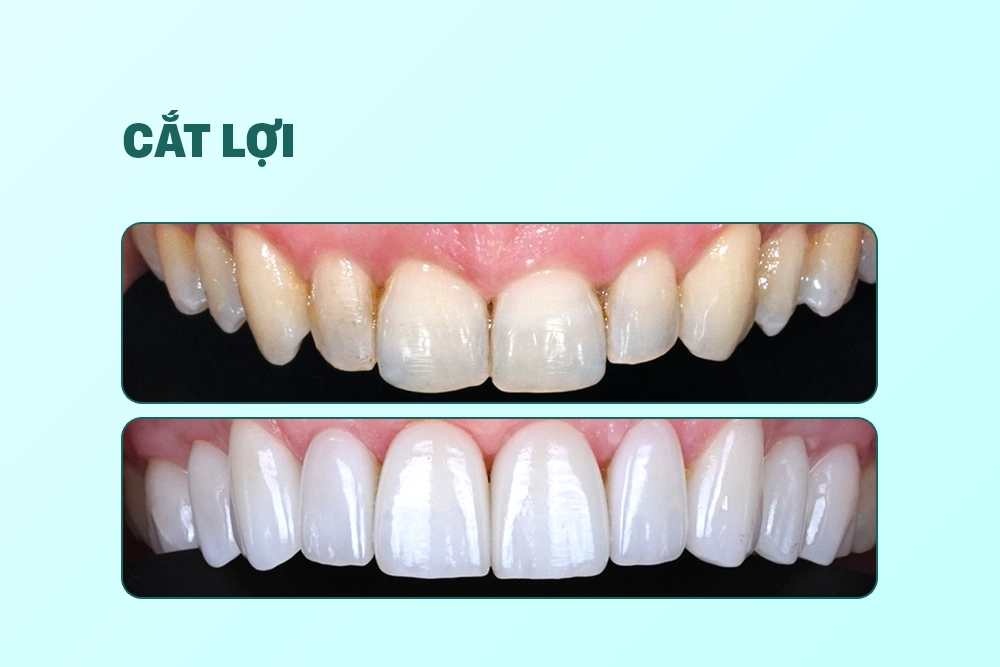 Cắt nướu kéo dài thân răng