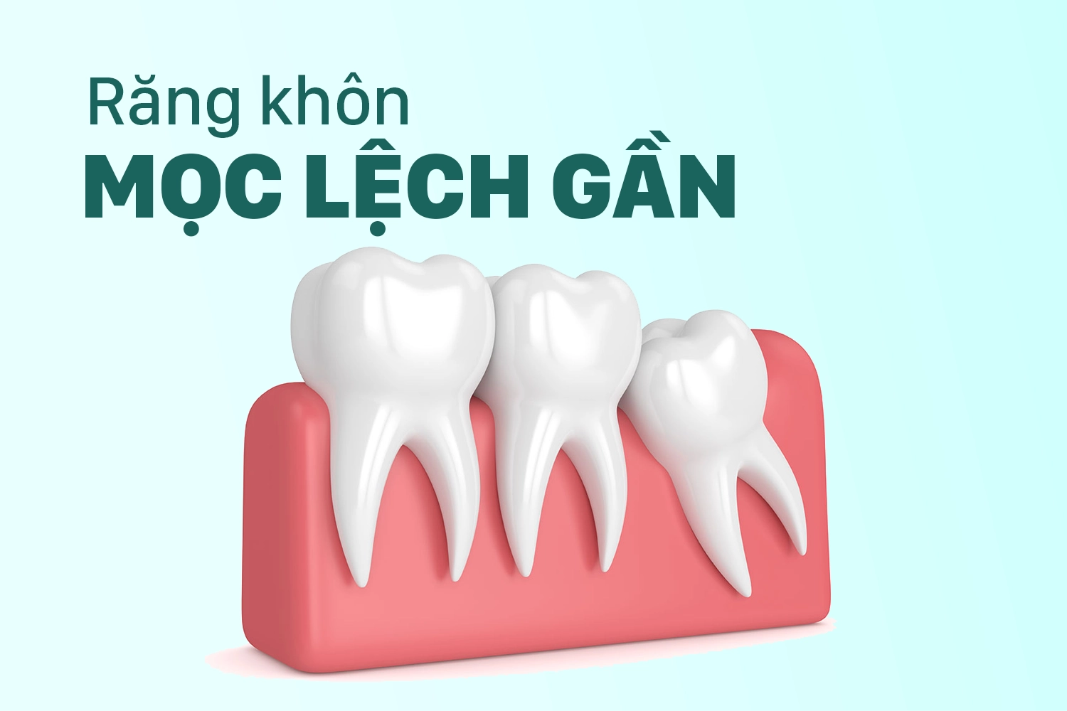 Hàm dưới mọc nghiêng 45 độ dưới xương