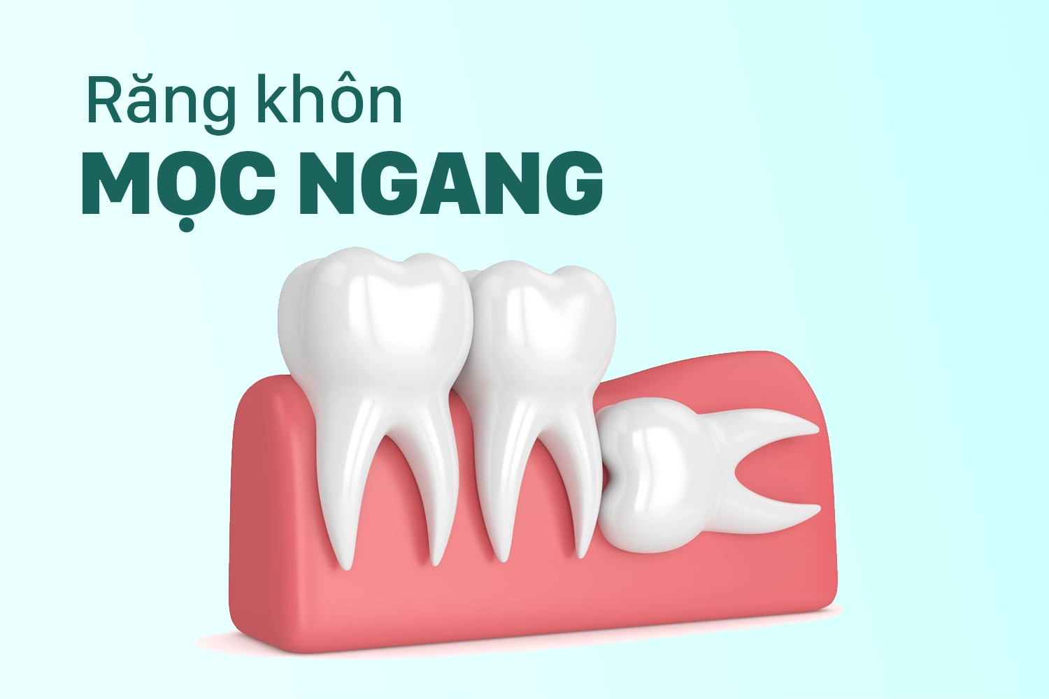 Hàm dưới mọc nghiêng 90 độ trên xương