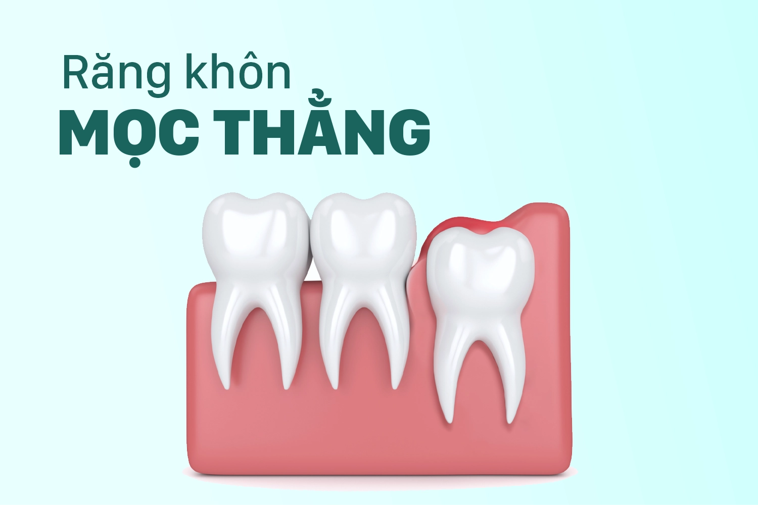 Hàm trên mọc ngầm