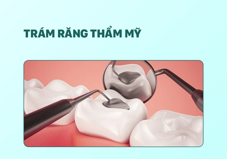 Trám răng thẩm mỹ