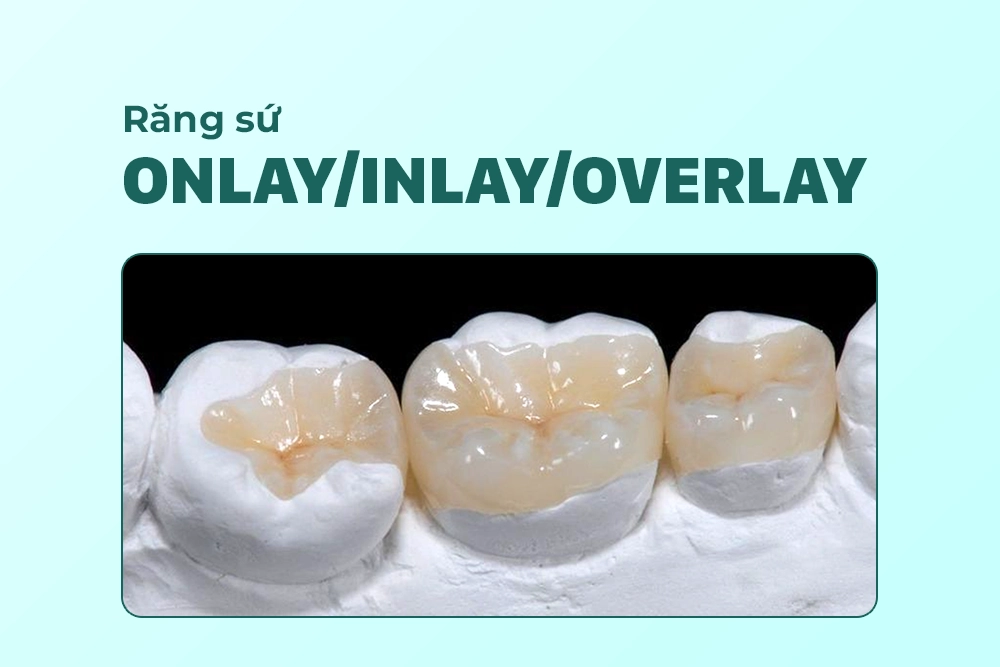 Onlay/Inlay/Overlay