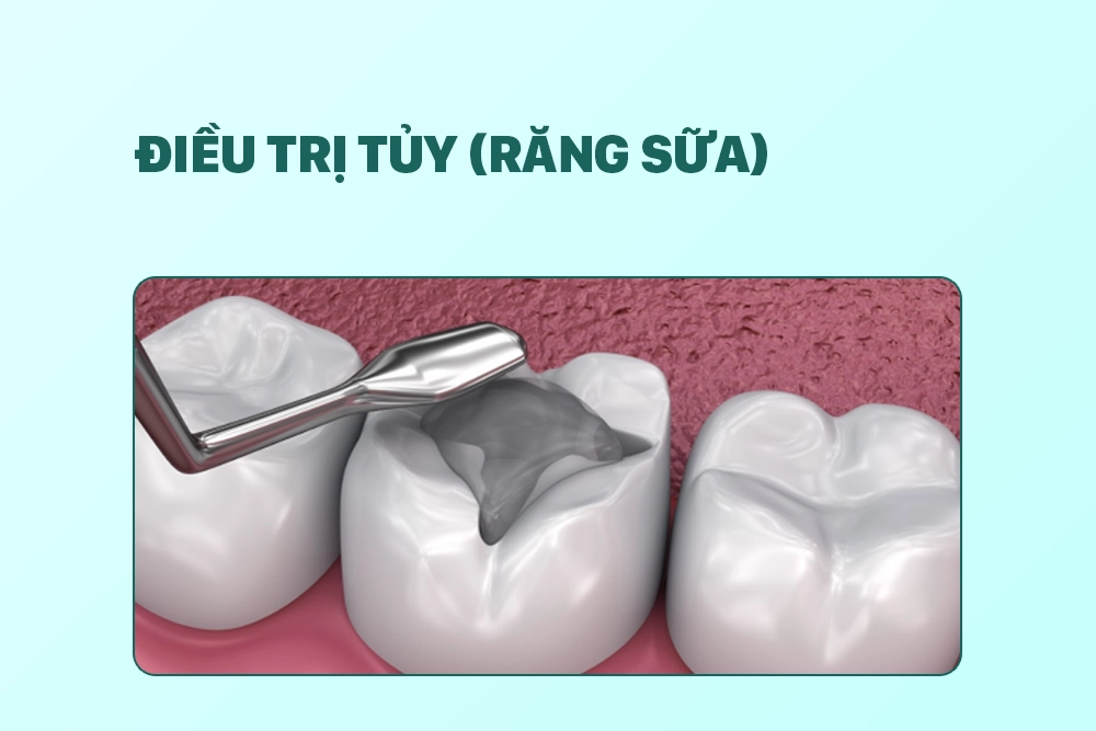 Điều trị tủy (răng sữa)