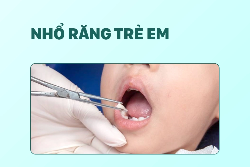 Nhổ răng trẻ em