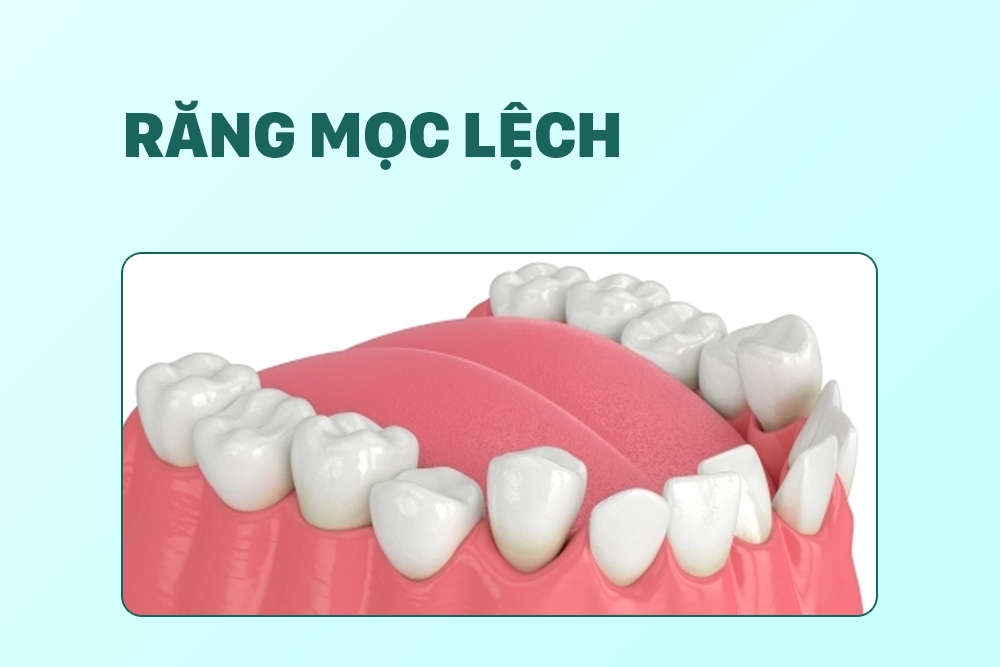 Răng mọc lệch