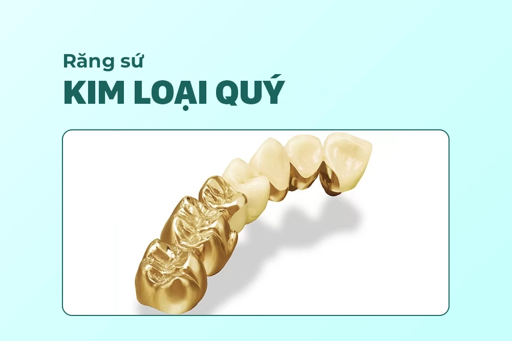Răng sứ Kim loại quý